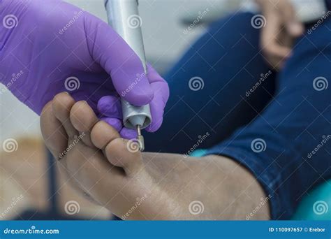 Podiatrist Remove Corns