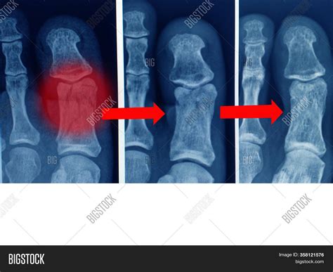 Fracture Toe Xray at Jackson Guilfoyle blog