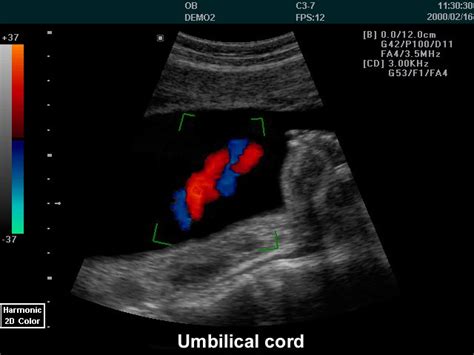 Bildergebnis für umbilical cord ultrasound images