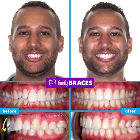 Braces Vs Invisalign For Overbite at Floyd Holley blog