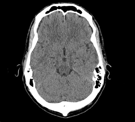 Image result for Normal Brain CT Scan