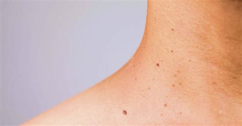 Skin Tag vs. Wart: Understanding the Difference - Skintify