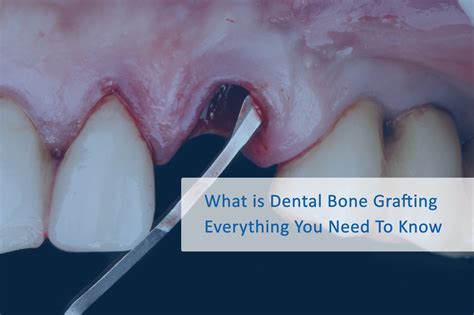 What is Dental Bone Grafting: Everything You Need To Know | Wellness Dental Studio