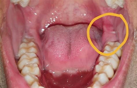 Swelling and pain in the region. Can't chew/eat. Occasional pain throat and ear region on the ...