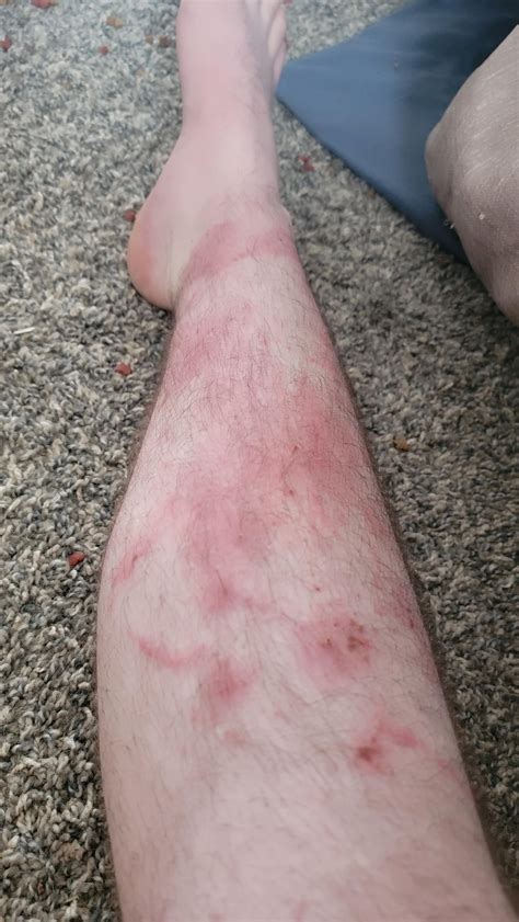 I have what is apperantly an *extremely* rare allergy to minoxidil : r/mildlyinfuriating