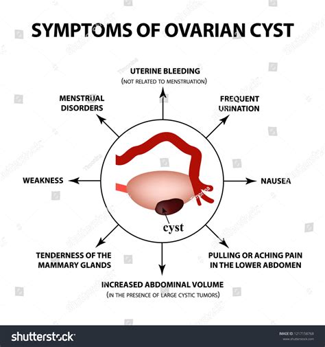 Symptoms Ovarian Cyst Ovaries Structure Infographics Stock Vector (Royalty Free) 1217158768 ...