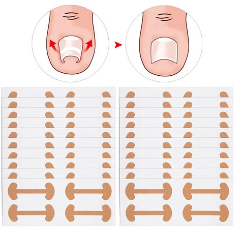 Buy Ingrown Toenail Corrector,Ingrown Toenail Correction Sticker ...