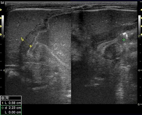 Pyloric Stenosis On Ultrasound