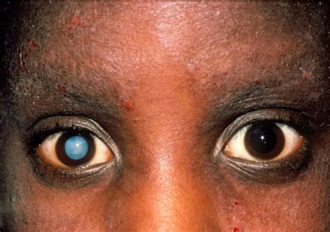 Cataract - Cataract - MSD Manual Professional Edition
