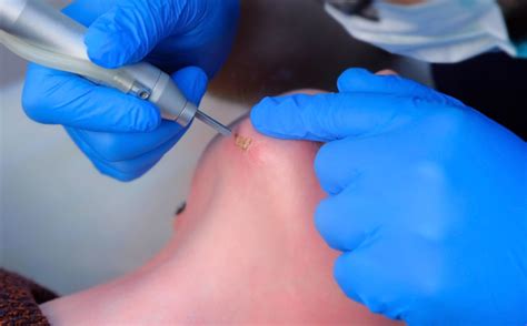 Best Skin Tag, Wart & Mole Removal in Navi Mumbai | Yuvani Aesthetic Clinic