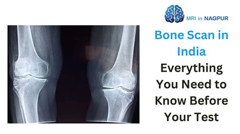 Bone Scan Testing 的图像结果