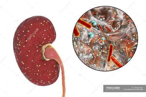 Abscess On Kidney