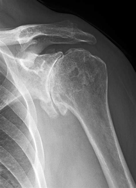 X Ray Of Shoulder Pain at Cynthia Burris blog