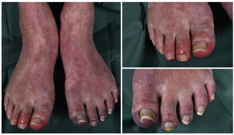 Intracardiac Thrombi in Morbus Adamantiades–Behçet in Two Swedish Patients