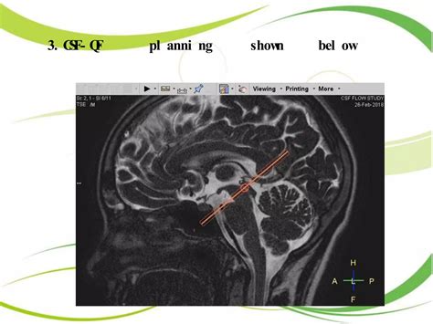 CSF Flow Study MRI 的图像结果