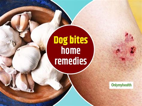 How To Treat A Dog Bite Naturally? Check Out These 7 Home Remedies ...