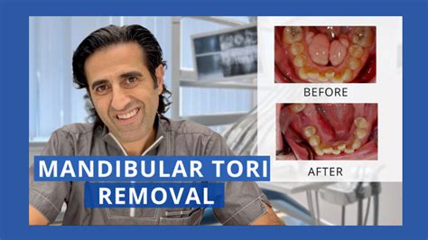 Prosthodontist Chevy Chase - Mandibular Tori Removal