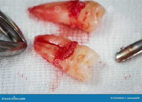 Image result for Tooth Extraction Tools