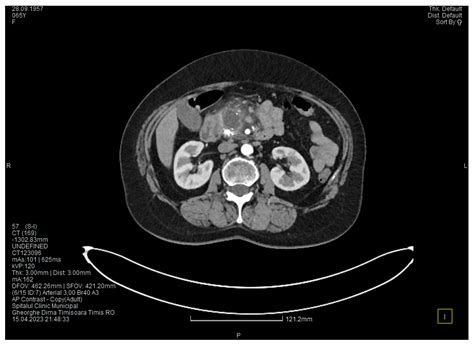 Pancreaticoduodenectomy with Anatomical Vascular Variant in Groove ...