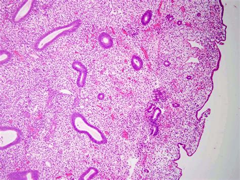 Thickened Uterine Lining Polyps at Loretta Little blog