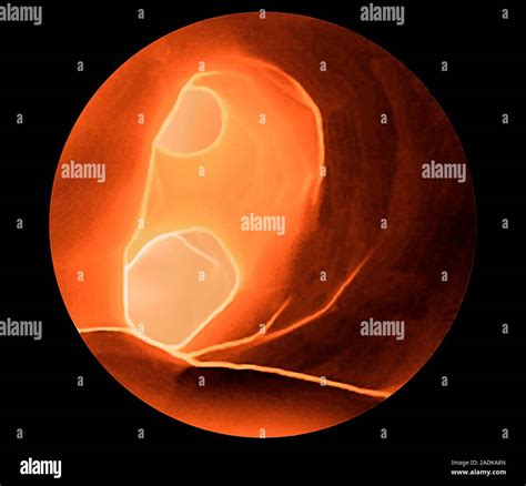 Carotid artery. Coloured 3D computed tomography (CT) scan of the ...
