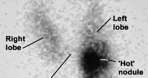 Image result for Radionuclide Scan