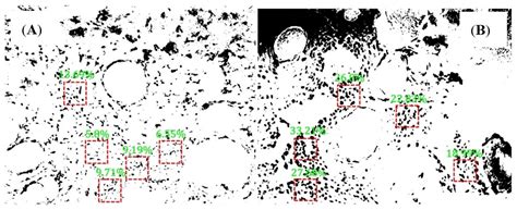 Segmentation and Recognition of the Pathological Features of Squamous ...