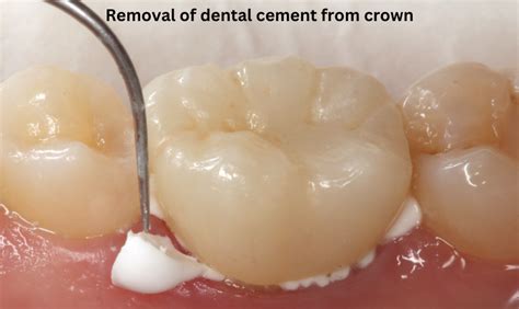 Tooth Crown Cement 的图像结果