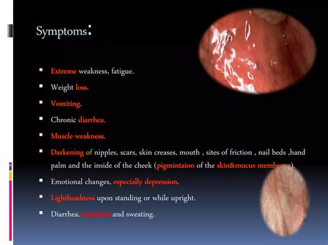 Addison’s disease | PPTX
