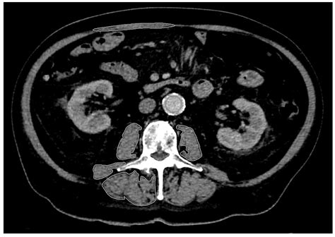 Applicability of the CT Radiomics of Skeletal Muscle and Machine ...