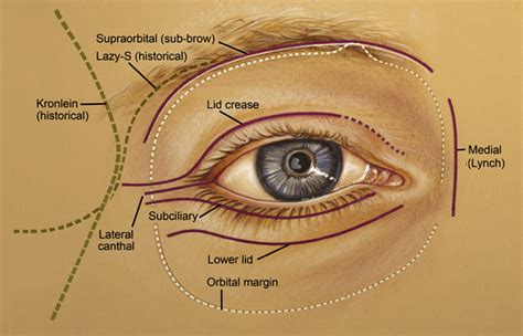 Orbital decompression for thyroid eye disease - Survey of Ophthalmology