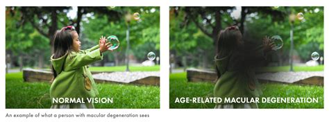 Image result for Macular Degeneration Vision Examples