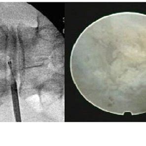 Image result for Disc FX Procedure
