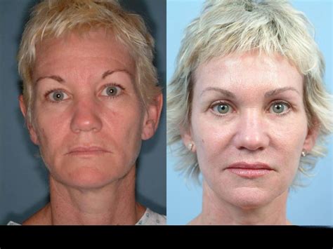 How Does Threading Face Lift Works 的图像结果