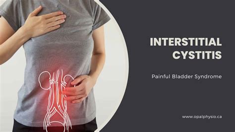 Interstitial Cystitis