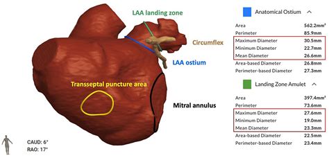 Left atrial appendage closure guided by fusion of 3D computational ...