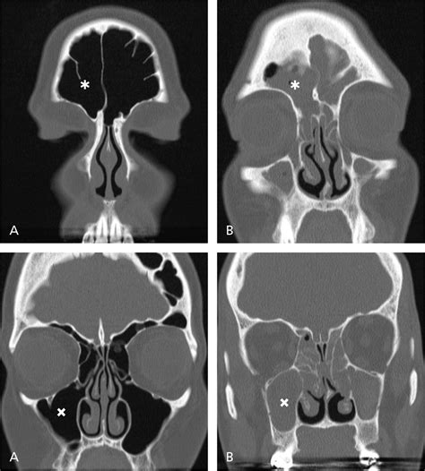 CT Scans Predict Recurrence of Nasal Polyps | Bluegrass Regional Imaging