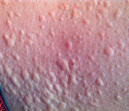 «The Big Three» der Dermatologie - Dermatologie - Universimed ...