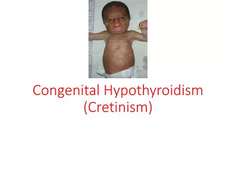 Hypothyroidism in children 2021 | PDF