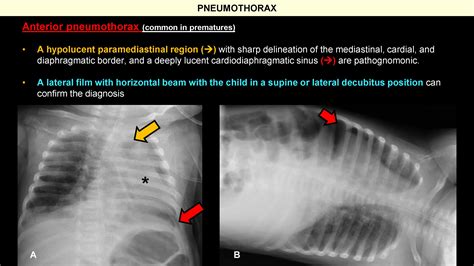 Atelectasia Vs Pneumotorax Eventration Of The Diaphragm Presenting As