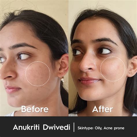 5% Niacinamide Serum - Improves Complexion & Reduces Pigmentation ...