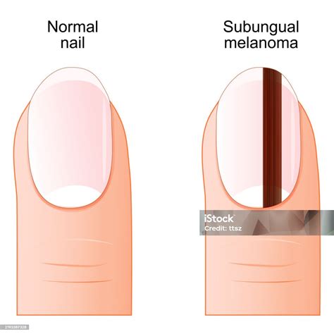 Subungual Melanoma Nail Cancer Stock Illustration - Download Image Now - Amelanotic Melanoma ...