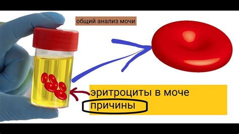Почему эритроциты в моче повышены: причины, норма