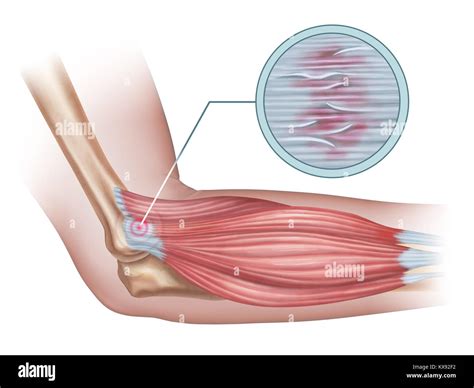 Tennis elbow hi-res stock photography and images - Alamy
