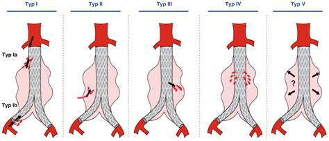 Implantable Pressure-Sensing Devices for Monitoring Abdominal Aortic ...