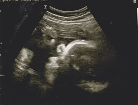 32 Weeks Ultrasound