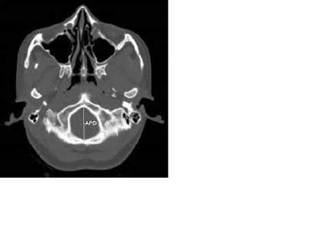 Forensic Perspective of Foramen Magnum|SDCINDIA