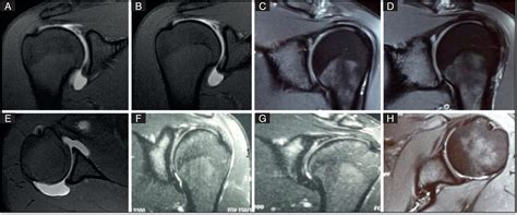 SciELO Brasil - SLAP IV IN OVERHEAD SPORTS PRACTICE SLAP IV IN OVERHEAD ...