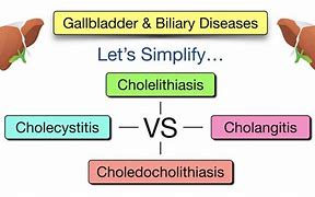 cholelithiasis 的图像结果