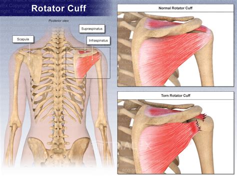 Image result for Left Rotator Cuff